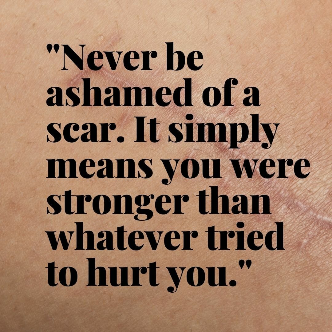 Never be ashamed of a scar. It simply means you were stronger that whatever tried to hurt you.