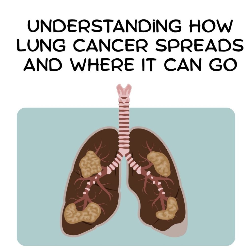 Understanding how lung cancer spreads and where it can go