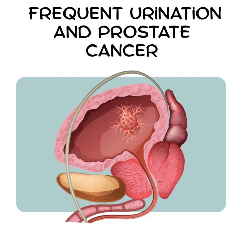 Frequent Urination and Prostate Cancer