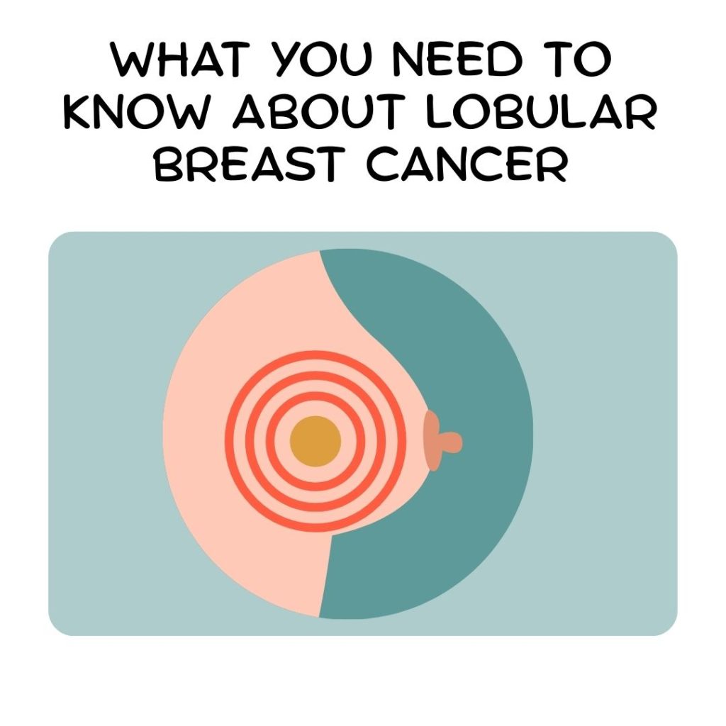 Your Guide to Lobular Breast Cancer