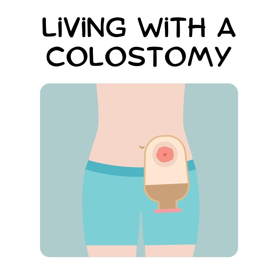 Living with a colostomy