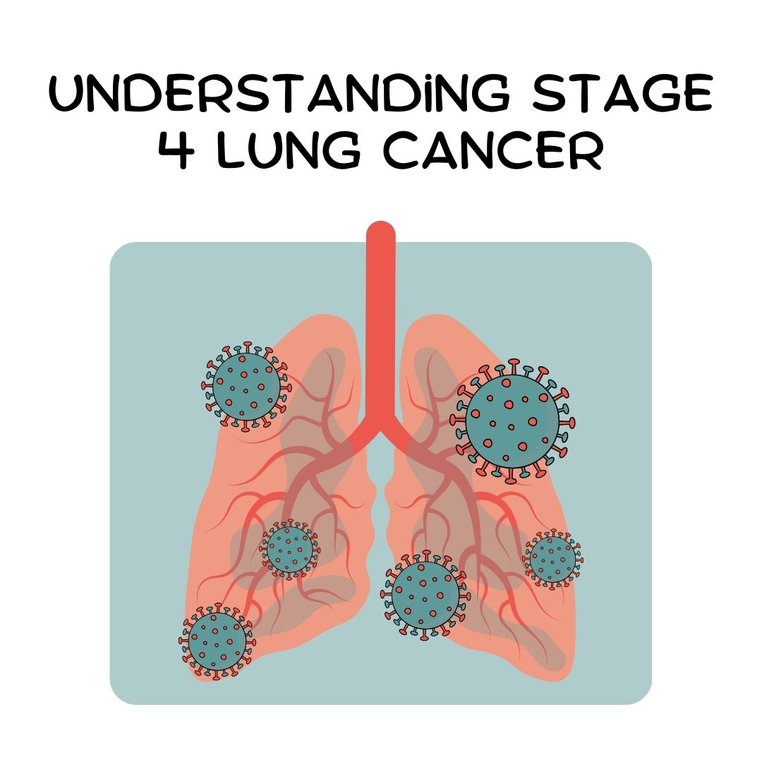 Understanding stage 4 lung cancer