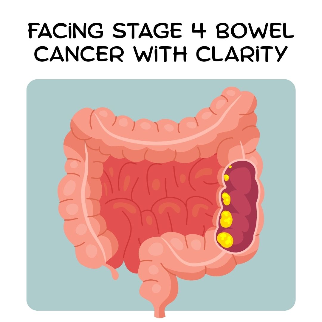 Navigating Stage 4 Bowel Cancer