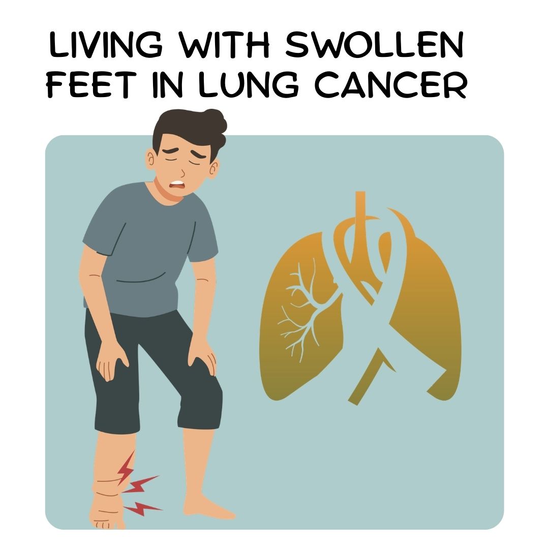Living with Swollen Feet in Lung Cancer