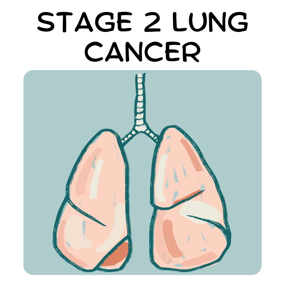 Stage 2 Lung Cancer