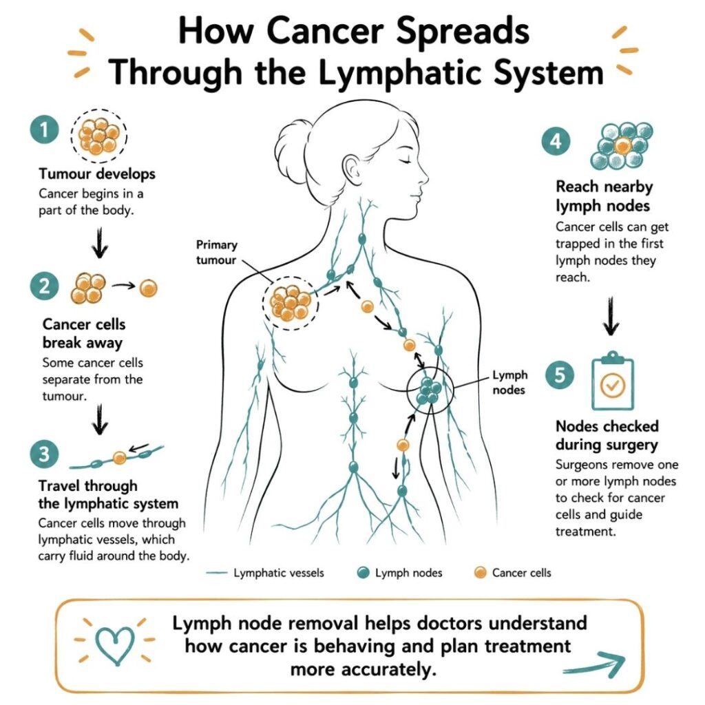 How cancer spreads through the lymphatic system